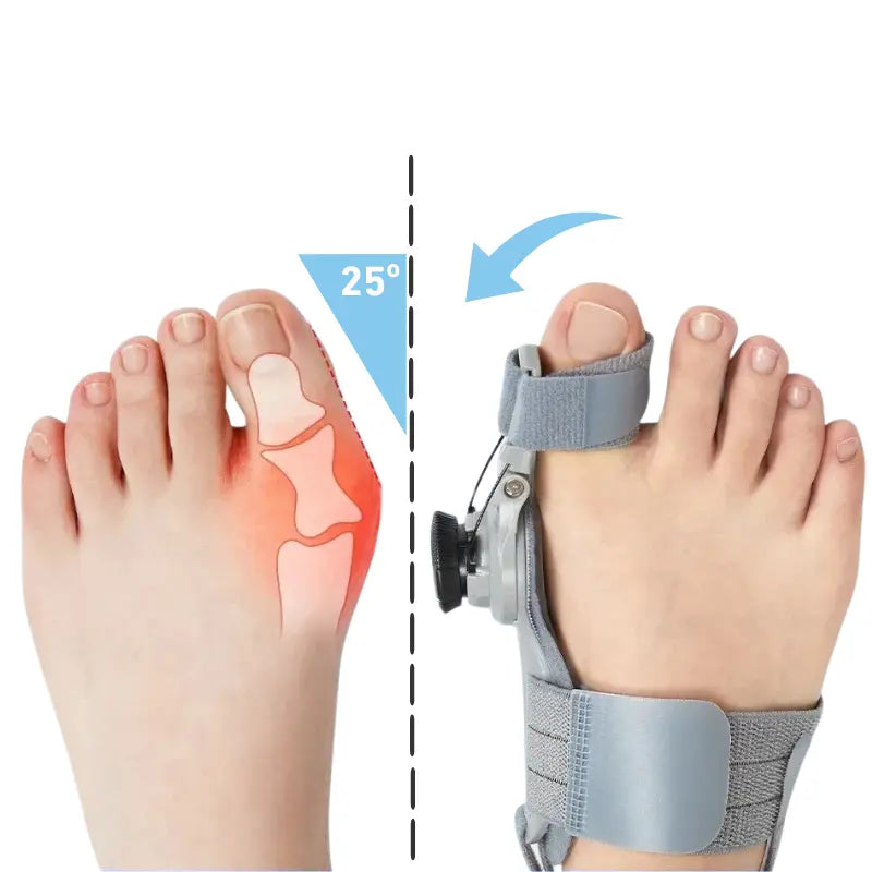 Attelle Correctrice d'Hallux Valgus