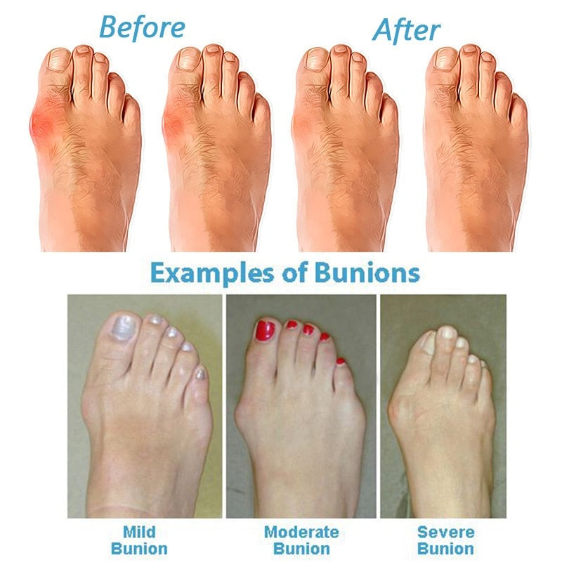 Women's Orthopedic Correcting Sandals - Stylish Supportive Footwear for Bunion Relief