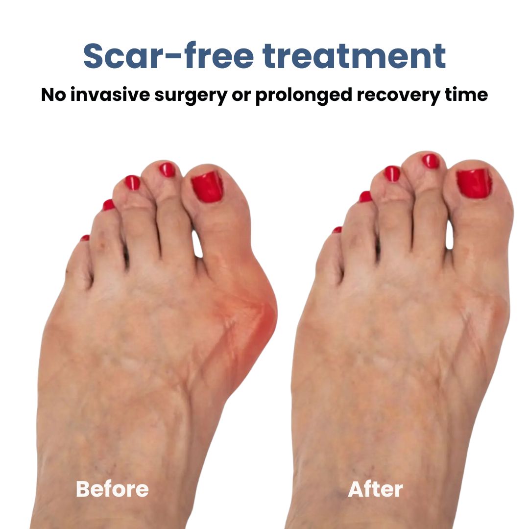 Attelle Correctrice d'Hallux Valgus